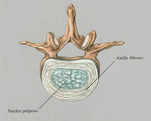disco intervertebral