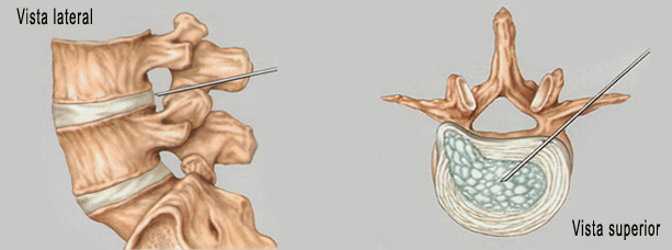 infiltracion de ozono en disco intervertebral