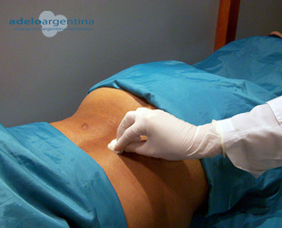 infiltración de ozono en hernia discal