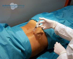 infiltración de ozono en hernia discal